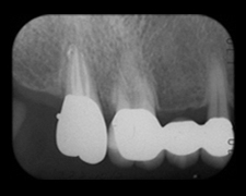 歯冠歯根破折